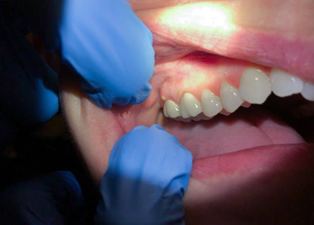 Best Emergency Dental Care for Broken or Chipped Teeth in Cockrell Hill, TX