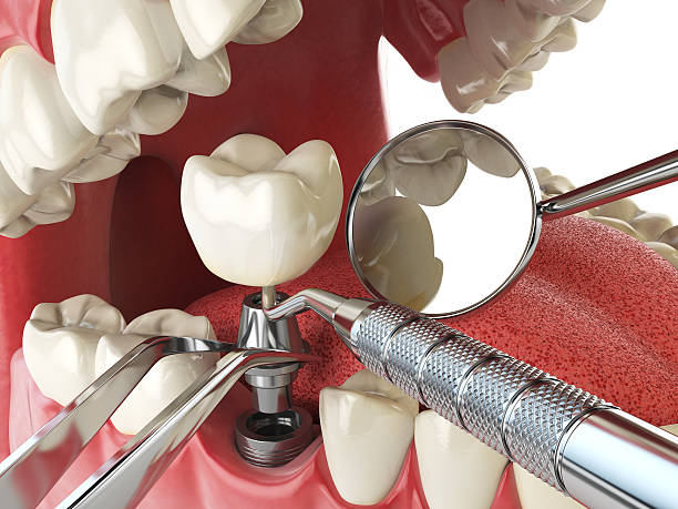 Best Emergency Tooth Extraction in Cockrell Hill, TX